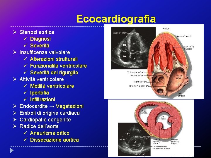 Ecocardiografia Ø Stenosi aortica ü Diagnosi ü Severità Ø Insufficenza valvolare ü Alterazioni strutturali