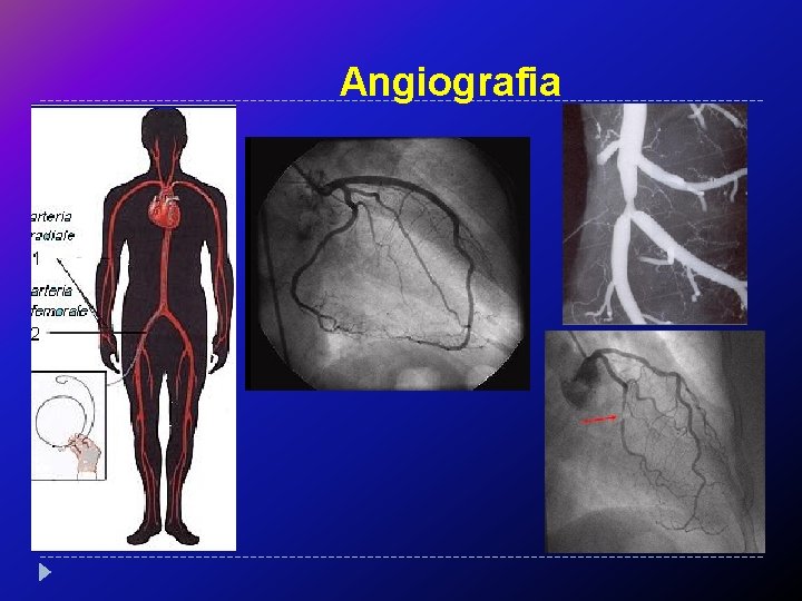 Angiografia 