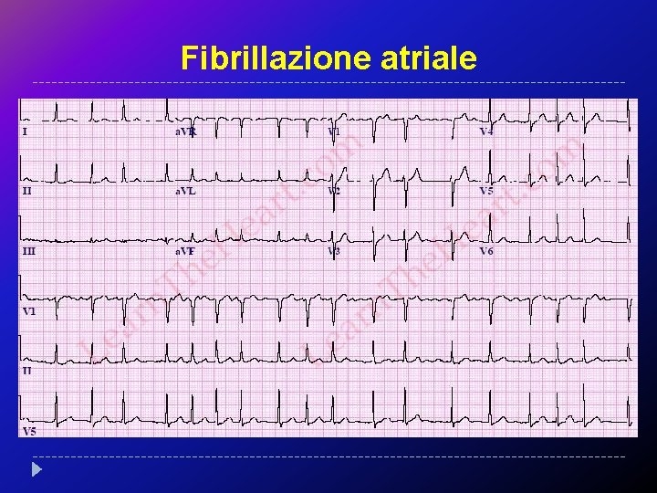 Fibrillazione atriale 