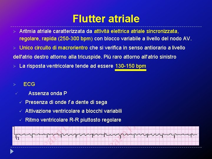 Flutter atriale Ø Aritmia atriale caratterizzata da attività elettrica atriale sincronizzata, regolare, rapida (250