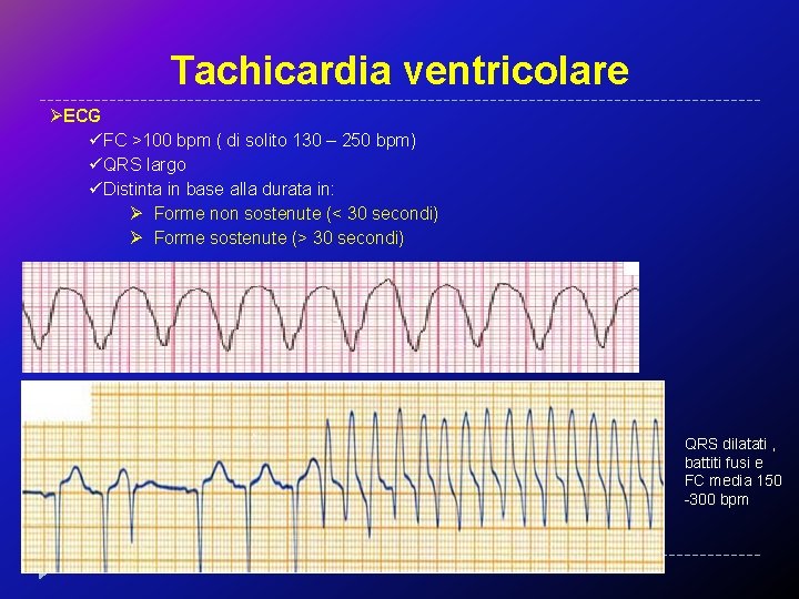 Tachicardia ventricolare ØECG üFC >100 bpm ( di solito 130 – 250 bpm) üQRS