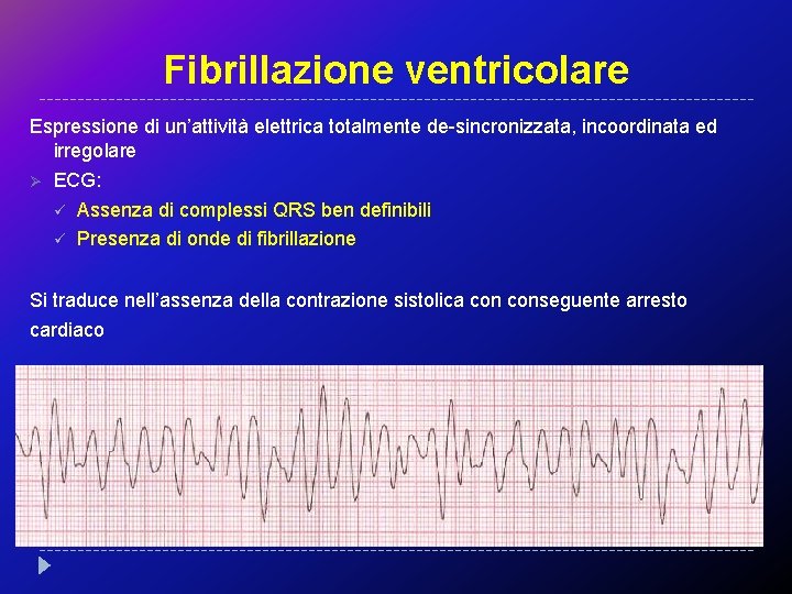 Fibrillazione ventricolare Espressione di un’attività elettrica totalmente de-sincronizzata, incoordinata ed irregolare Ø ECG: ü