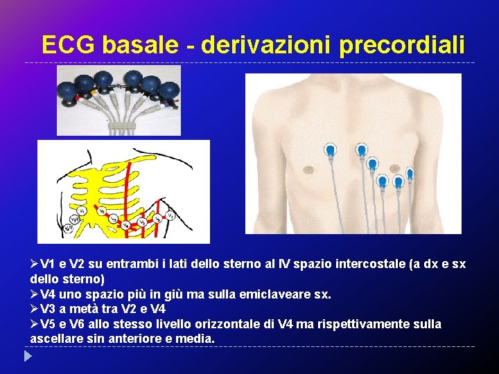 ECG basale - derivazioni precordiali ØV 1 e V 2 su entrambi i lati