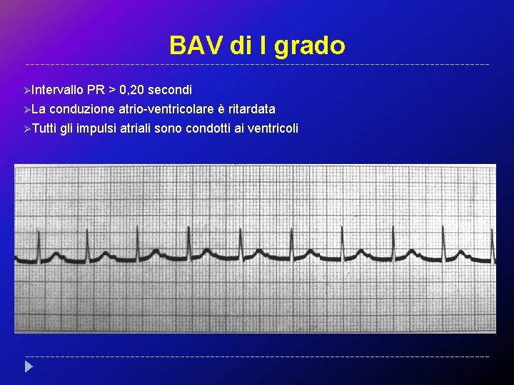 BAV di I grado ØIntervallo PR > 0, 20 secondi ØLa conduzione atrio-ventricolare è