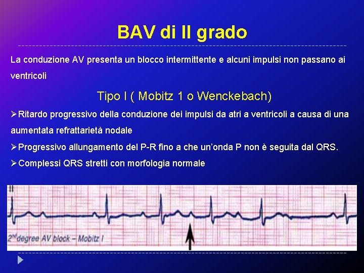 BAV di II grado La conduzione AV presenta un blocco intermittente e alcuni impulsi