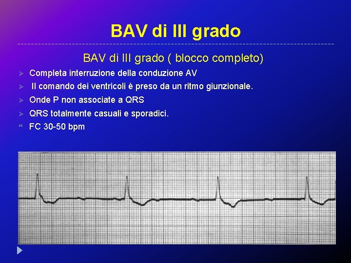 BAV di III grado ( blocco completo) Ø Completa interruzione della conduzione AV Ø