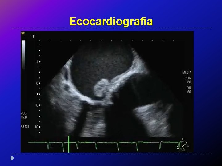 Ecocardiografia 