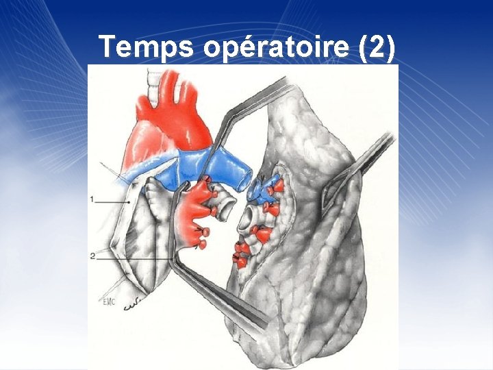 Temps opératoire (2) 