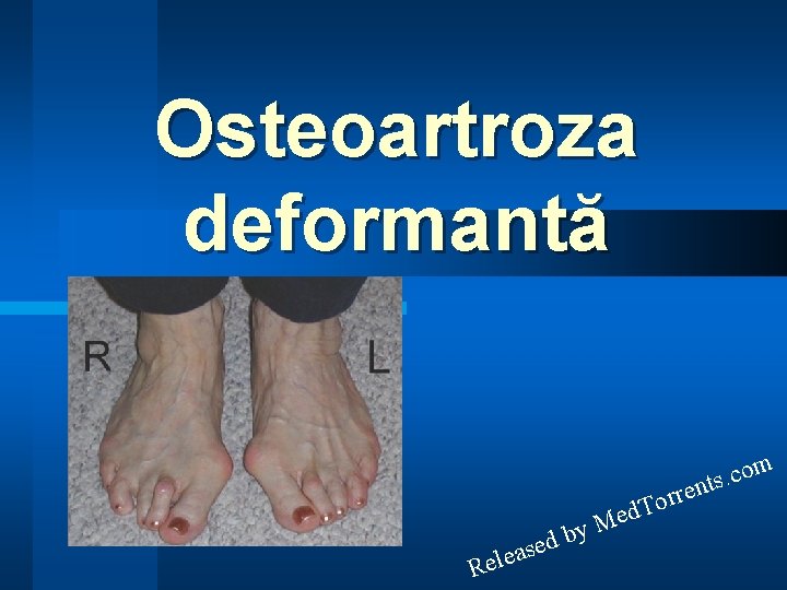 Osteoartroza deformantă m o c. s ent M rr o T ed a e