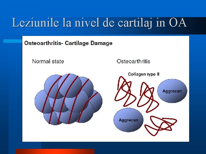 Leziunile la nivel de cartilaj in OA 