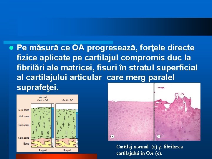 l Pe măsură ce OA progresează, forţele directe fizice aplicate pe cartilajul compromis duc l Pe măsură ce OA progresează, forţele directe fizice aplicate pe cartilajul compromis duc