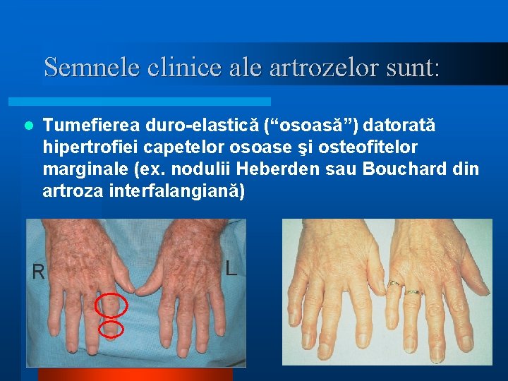 Semnele clinice ale artrozelor sunt: l Tumefierea duro-elastică (“osoasă”) datorată hipertrofiei capetelor osoase şi