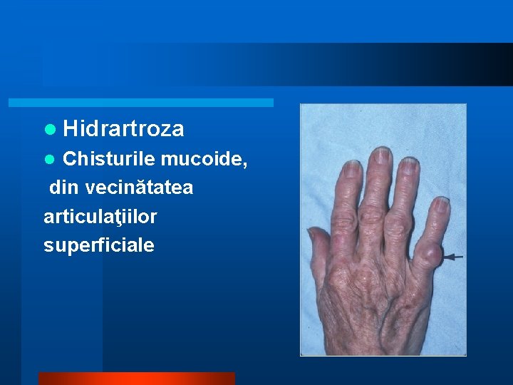 l Hidrartroza Chisturile mucoide, din vecinătatea articulaţiilor superficiale l 