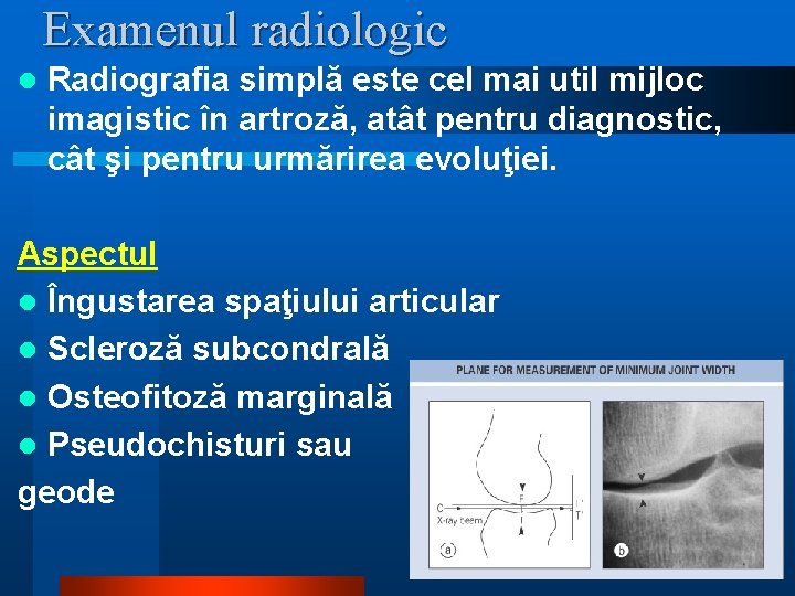 Examenul radiologic l Radiografia simplă este cel mai util mijloc imagistic în artroză, atât