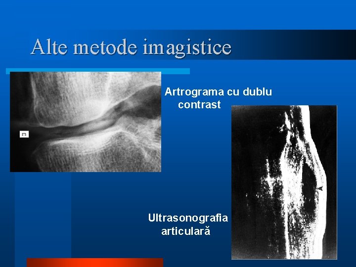 Alte metode imagistice Artrograma cu dublu contrast Ultrasonografia articulară 