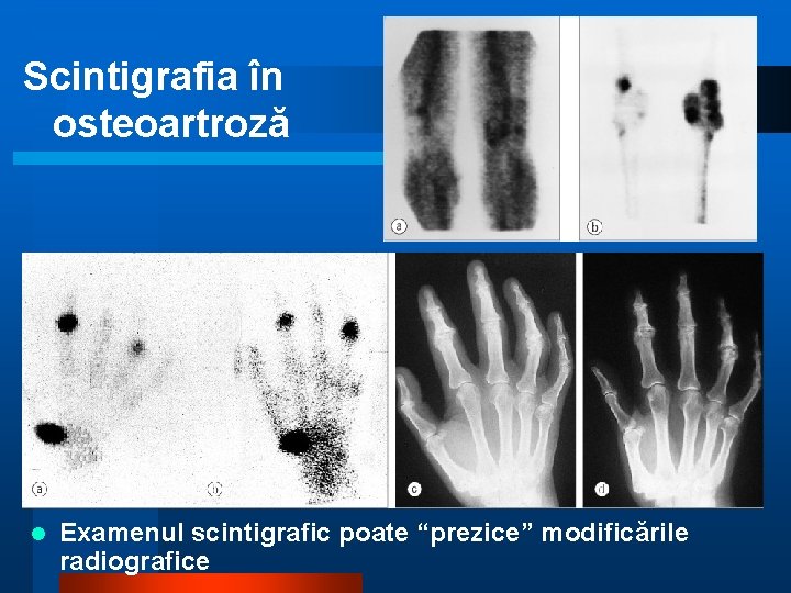 Scintigrafia în osteoartroză l Examenul scintigrafic poate “prezice” modificările radiografice 