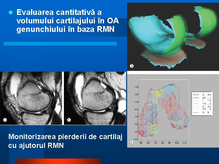 l Evaluarea cantitativă a volumului cartilajului în OA genunchiului în baza RMN Monitorizarea pierderii