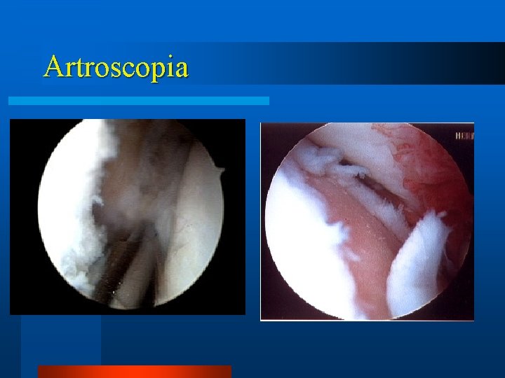 Artroscopia 