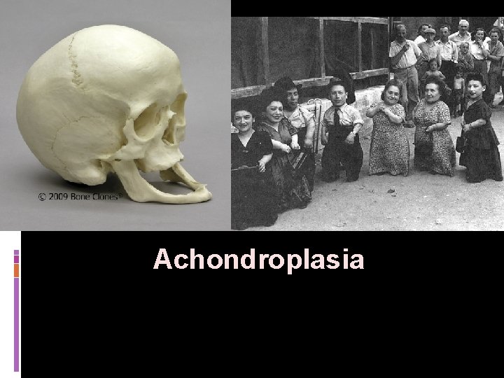 Achondroplasia 