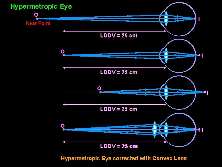 Hypermetropic Eye O I Near Point LDDV = 25 cm O II LDDV =