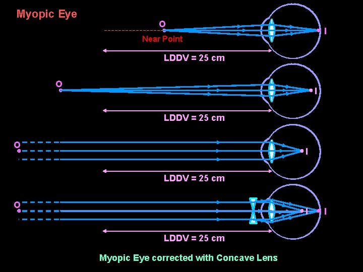 Myopic Eye O I Near Point LDDV = 25 cm O I LDDV =