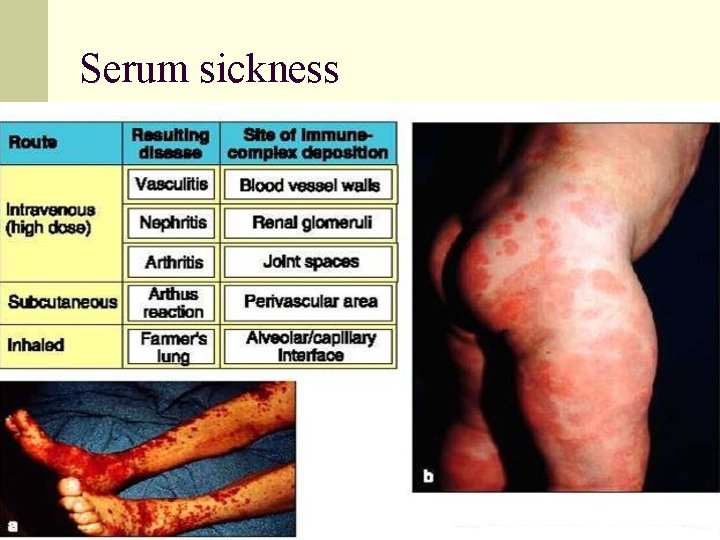 Serum sickness 