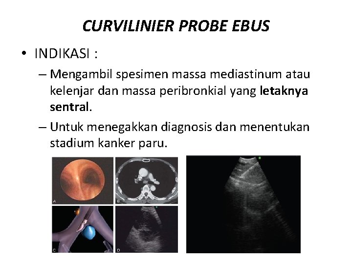 CURVILINIER PROBE EBUS • INDIKASI : – Mengambil spesimen massa mediastinum atau kelenjar dan