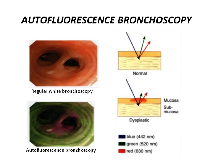 AUTOFLUORESCENCE BRONCHOSCOPY Regular white bronchoscopy Autofluorescence bronchoscopy 