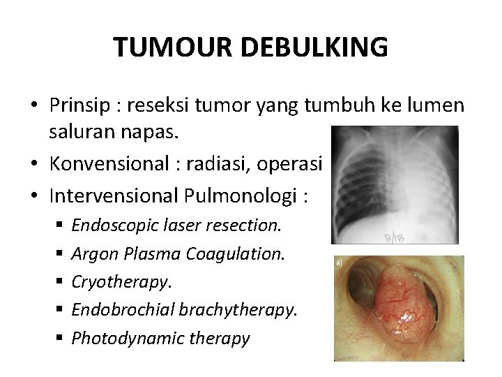 TUMOUR DEBULKING • Prinsip : reseksi tumor yang tumbuh ke lumen saluran napas. •