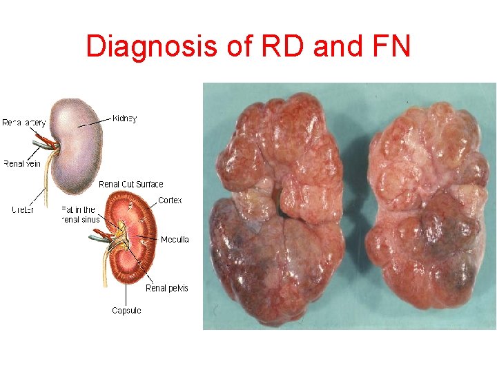 Diagnosis of RD and FN 