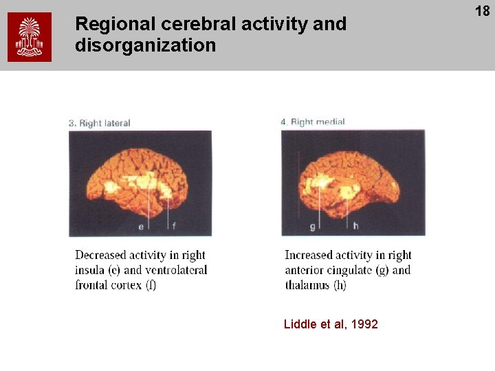 Regional cerebral activity and disorganization Liddle et al, 1992 18 
