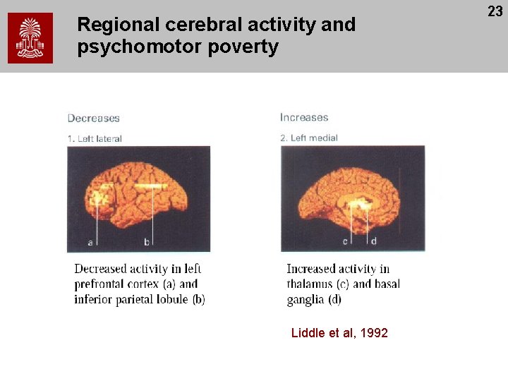 Regional cerebral activity and psychomotor poverty Liddle et al, 1992 23 