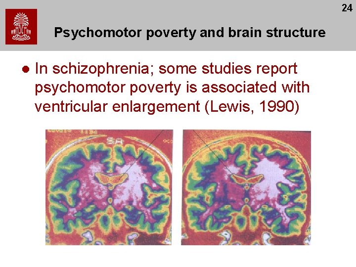 24 Psychomotor poverty and brain structure l In schizophrenia; some studies report psychomotor poverty