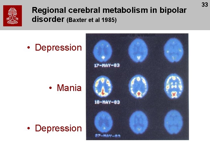 Regional cerebral metabolism in bipolar disorder (Baxter et al 1985) • Depression • Mania
