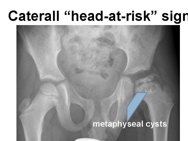 Caterall “head-at-risk” sign metaphyseal cysts 