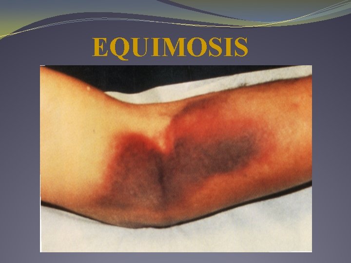 EQUIMOSIS EQUIMOSIS