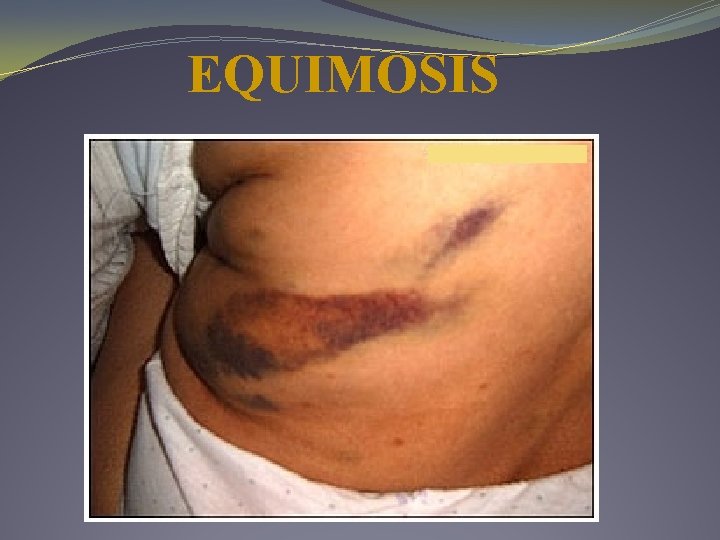 EQUIMOSIS EQUIMOSIS