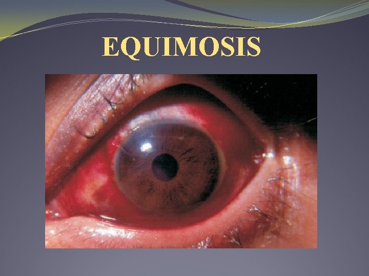 EQUIMOSIS EQUIMOSIS