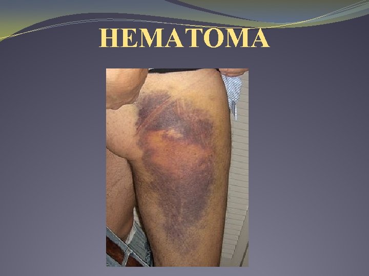 HEMATOMA HEMATOMA