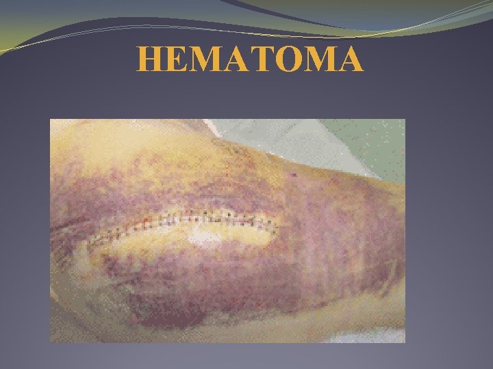 HEMATOMA HEMATOMA