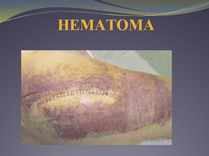 HEMATOMA 