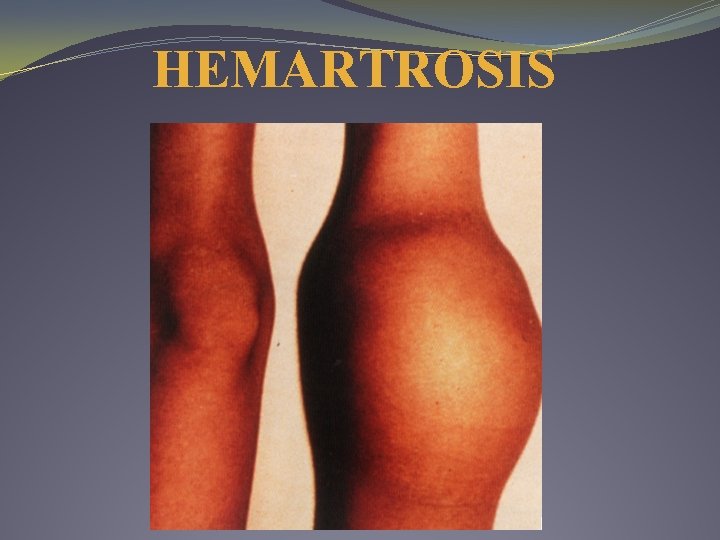 HEMARTROSIS 