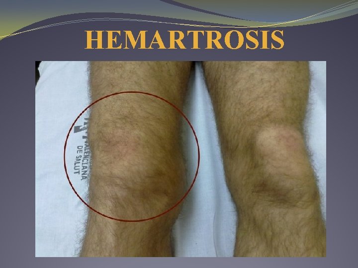 HEMARTROSIS HEMARTROSIS