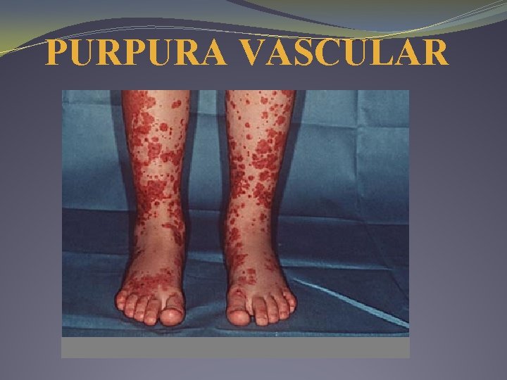PURPURA VASCULAR PURPURA VASCULAR