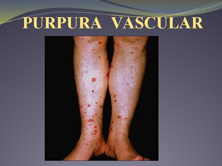 PURPURA VASCULAR PURPURA VASCULAR