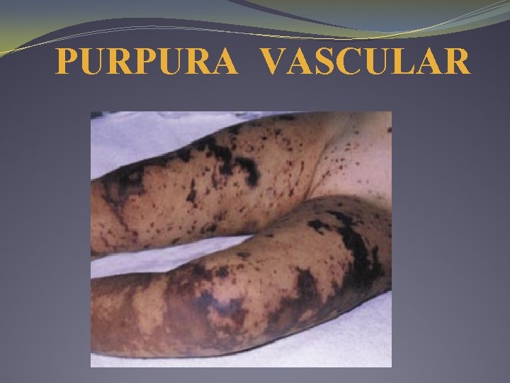 PURPURA VASCULAR 