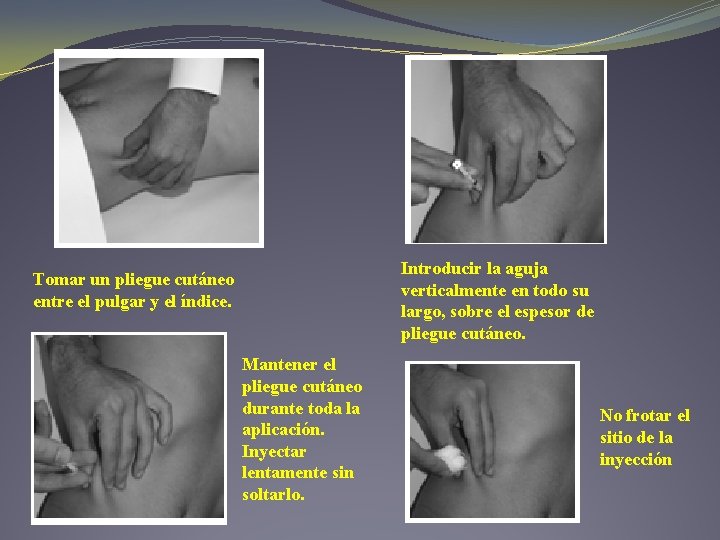 Introducir la aguja verticalmente en todo su largo, sobre el espesor de pliegue cutáneo.