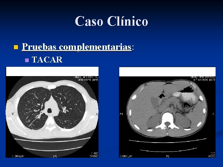 Caso Clínico n Pruebas complementarias: n TACAR Caso Clínico n Pruebas complementarias: n TACAR