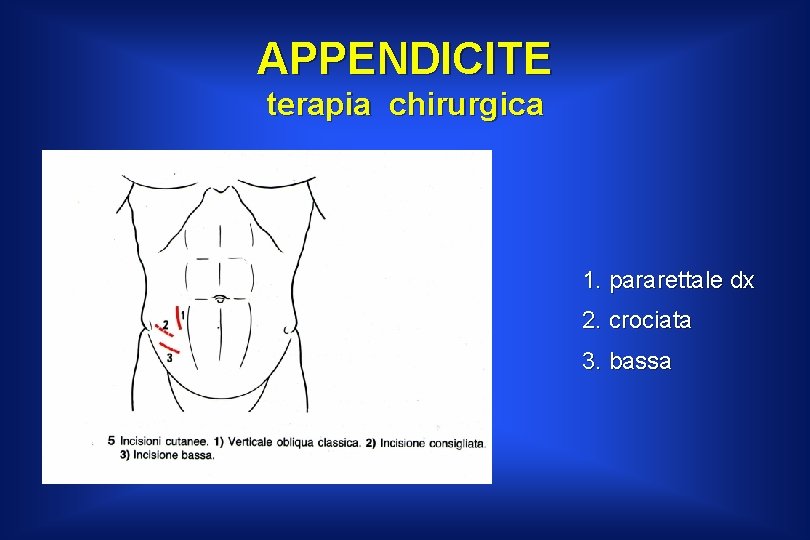 APPENDICITE terapia chirurgica 1. pararettale dx 2. crociata 3. bassa 