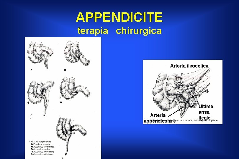 APPENDICITE terapia chirurgica Arteria ileocolica Arteria appendicolare Ultima ansa ileale 